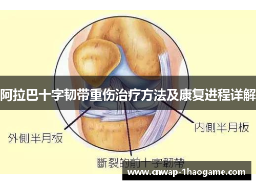 阿拉巴十字韧带重伤治疗方法及康复进程详解 阿拉巴十字韧带重伤治疗方法及康复进程详解